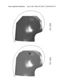 PATIENT-ADAPTED AND IMPROVED ARTICULAR IMPLANTS, DESIGNS AND RELATED GUIDE     TOOLS diagram and image