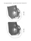 PATIENT-ADAPTED AND IMPROVED ARTICULAR IMPLANTS, DESIGNS AND RELATED GUIDE     TOOLS diagram and image