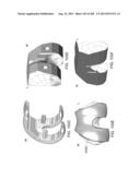 PATIENT-ADAPTED AND IMPROVED ARTICULAR IMPLANTS, DESIGNS AND RELATED GUIDE     TOOLS diagram and image