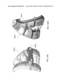 PATIENT-ADAPTED AND IMPROVED ARTICULAR IMPLANTS, DESIGNS AND RELATED GUIDE     TOOLS diagram and image