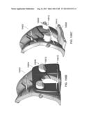 PATIENT-ADAPTED AND IMPROVED ARTICULAR IMPLANTS, DESIGNS AND RELATED GUIDE     TOOLS diagram and image