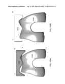 PATIENT-ADAPTED AND IMPROVED ARTICULAR IMPLANTS, DESIGNS AND RELATED GUIDE     TOOLS diagram and image