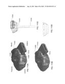 PATIENT-ADAPTED AND IMPROVED ARTICULAR IMPLANTS, DESIGNS AND RELATED GUIDE     TOOLS diagram and image