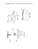 PATIENT-ADAPTED AND IMPROVED ARTICULAR IMPLANTS, DESIGNS AND RELATED GUIDE     TOOLS diagram and image