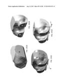 PATIENT-ADAPTED AND IMPROVED ARTICULAR IMPLANTS, DESIGNS AND RELATED GUIDE     TOOLS diagram and image