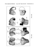 PATIENT-ADAPTED AND IMPROVED ARTICULAR IMPLANTS, DESIGNS AND RELATED GUIDE     TOOLS diagram and image