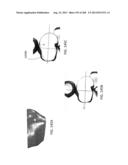 PATIENT-ADAPTED AND IMPROVED ARTICULAR IMPLANTS, DESIGNS AND RELATED GUIDE     TOOLS diagram and image