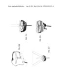 PATIENT-ADAPTED AND IMPROVED ARTICULAR IMPLANTS, DESIGNS AND RELATED GUIDE     TOOLS diagram and image