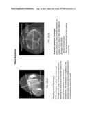 PATIENT-ADAPTED AND IMPROVED ARTICULAR IMPLANTS, DESIGNS AND RELATED GUIDE     TOOLS diagram and image