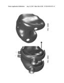 PATIENT-ADAPTED AND IMPROVED ARTICULAR IMPLANTS, DESIGNS AND RELATED GUIDE     TOOLS diagram and image