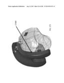 PATIENT-ADAPTED AND IMPROVED ARTICULAR IMPLANTS, DESIGNS AND RELATED GUIDE     TOOLS diagram and image