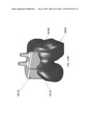 PATIENT-ADAPTED AND IMPROVED ARTICULAR IMPLANTS, DESIGNS AND RELATED GUIDE     TOOLS diagram and image