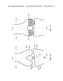 PATIENT-ADAPTED AND IMPROVED ARTICULAR IMPLANTS, DESIGNS AND RELATED GUIDE     TOOLS diagram and image