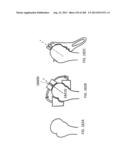 PATIENT-ADAPTED AND IMPROVED ARTICULAR IMPLANTS, DESIGNS AND RELATED GUIDE     TOOLS diagram and image