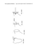 PATIENT-ADAPTED AND IMPROVED ARTICULAR IMPLANTS, DESIGNS AND RELATED GUIDE     TOOLS diagram and image