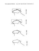 PATIENT-ADAPTED AND IMPROVED ARTICULAR IMPLANTS, DESIGNS AND RELATED GUIDE     TOOLS diagram and image