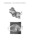 PATIENT-ADAPTED AND IMPROVED ARTICULAR IMPLANTS, DESIGNS AND RELATED GUIDE     TOOLS diagram and image