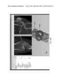 PATIENT-ADAPTED AND IMPROVED ARTICULAR IMPLANTS, DESIGNS AND RELATED GUIDE     TOOLS diagram and image