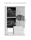 PATIENT-ADAPTED AND IMPROVED ARTICULAR IMPLANTS, DESIGNS AND RELATED GUIDE     TOOLS diagram and image