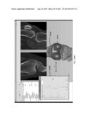 PATIENT-ADAPTED AND IMPROVED ARTICULAR IMPLANTS, DESIGNS AND RELATED GUIDE     TOOLS diagram and image