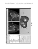 PATIENT-ADAPTED AND IMPROVED ARTICULAR IMPLANTS, DESIGNS AND RELATED GUIDE     TOOLS diagram and image