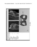 PATIENT-ADAPTED AND IMPROVED ARTICULAR IMPLANTS, DESIGNS AND RELATED GUIDE     TOOLS diagram and image