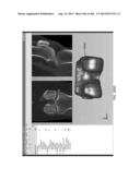 PATIENT-ADAPTED AND IMPROVED ARTICULAR IMPLANTS, DESIGNS AND RELATED GUIDE     TOOLS diagram and image