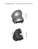 PATIENT-ADAPTED AND IMPROVED ARTICULAR IMPLANTS, DESIGNS AND RELATED GUIDE     TOOLS diagram and image