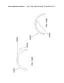 PATIENT-ADAPTED AND IMPROVED ARTICULAR IMPLANTS, DESIGNS AND RELATED GUIDE     TOOLS diagram and image