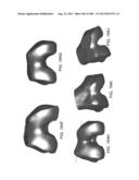 PATIENT-ADAPTED AND IMPROVED ARTICULAR IMPLANTS, DESIGNS AND RELATED GUIDE     TOOLS diagram and image