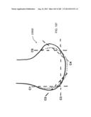 PATIENT-ADAPTED AND IMPROVED ARTICULAR IMPLANTS, DESIGNS AND RELATED GUIDE     TOOLS diagram and image