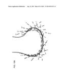 PATIENT-ADAPTED AND IMPROVED ARTICULAR IMPLANTS, DESIGNS AND RELATED GUIDE     TOOLS diagram and image