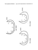 PATIENT-ADAPTED AND IMPROVED ARTICULAR IMPLANTS, DESIGNS AND RELATED GUIDE     TOOLS diagram and image