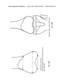 PATIENT-ADAPTED AND IMPROVED ARTICULAR IMPLANTS, DESIGNS AND RELATED GUIDE     TOOLS diagram and image