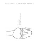 PATIENT-ADAPTED AND IMPROVED ARTICULAR IMPLANTS, DESIGNS AND RELATED GUIDE     TOOLS diagram and image