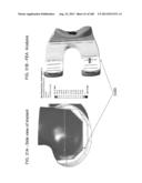 PATIENT-ADAPTED AND IMPROVED ARTICULAR IMPLANTS, DESIGNS AND RELATED GUIDE     TOOLS diagram and image