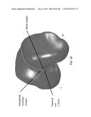 PATIENT-ADAPTED AND IMPROVED ARTICULAR IMPLANTS, DESIGNS AND RELATED GUIDE     TOOLS diagram and image