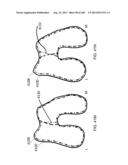 PATIENT-ADAPTED AND IMPROVED ARTICULAR IMPLANTS, DESIGNS AND RELATED GUIDE     TOOLS diagram and image