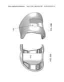 PATIENT-ADAPTED AND IMPROVED ARTICULAR IMPLANTS, DESIGNS AND RELATED GUIDE     TOOLS diagram and image