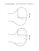 PATIENT-ADAPTED AND IMPROVED ARTICULAR IMPLANTS, DESIGNS AND RELATED GUIDE     TOOLS diagram and image