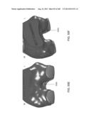 PATIENT-ADAPTED AND IMPROVED ARTICULAR IMPLANTS, DESIGNS AND RELATED GUIDE     TOOLS diagram and image