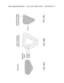 PATIENT-ADAPTED AND IMPROVED ARTICULAR IMPLANTS, DESIGNS AND RELATED GUIDE     TOOLS diagram and image