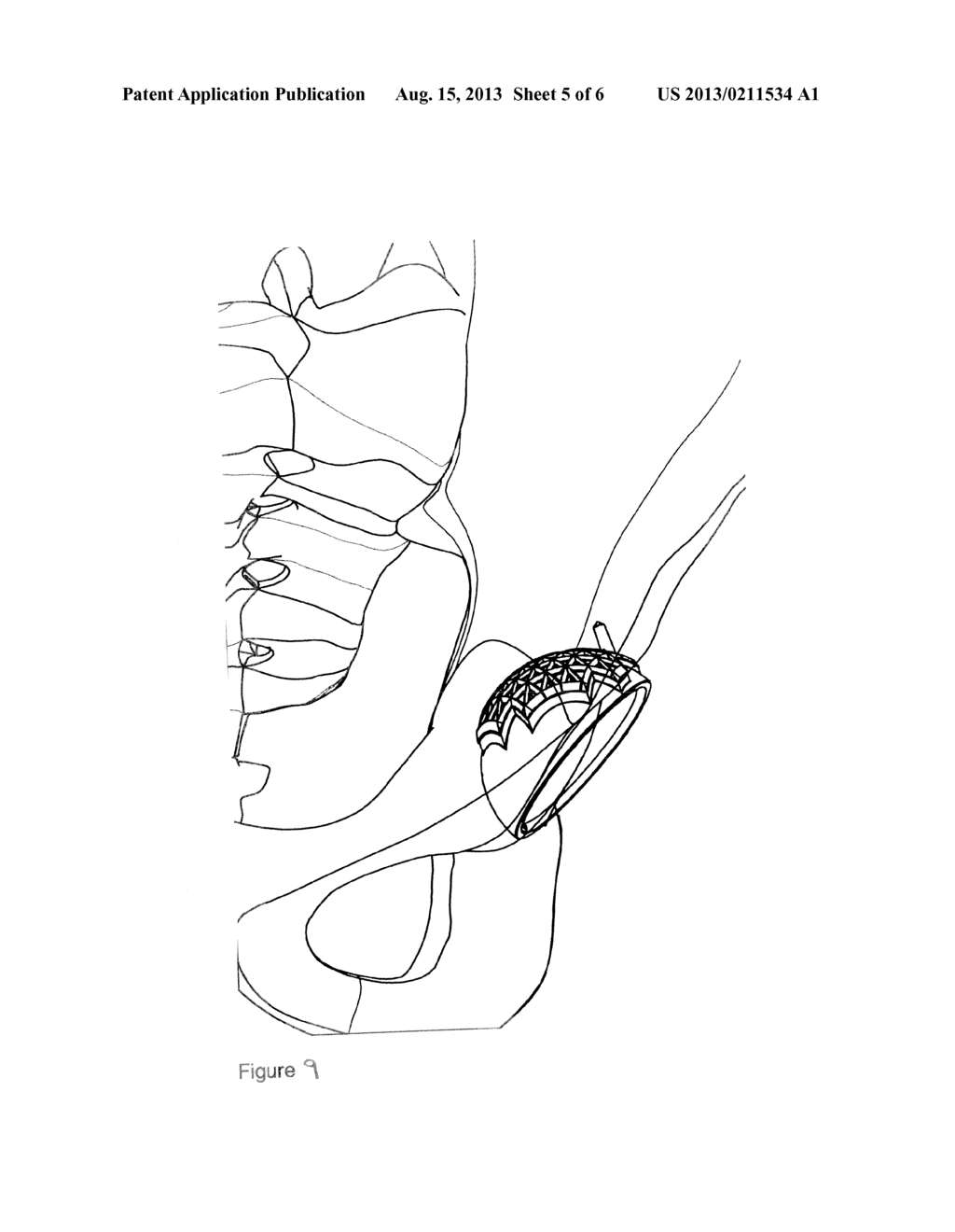 PROSTHESIS - diagram, schematic, and image 06