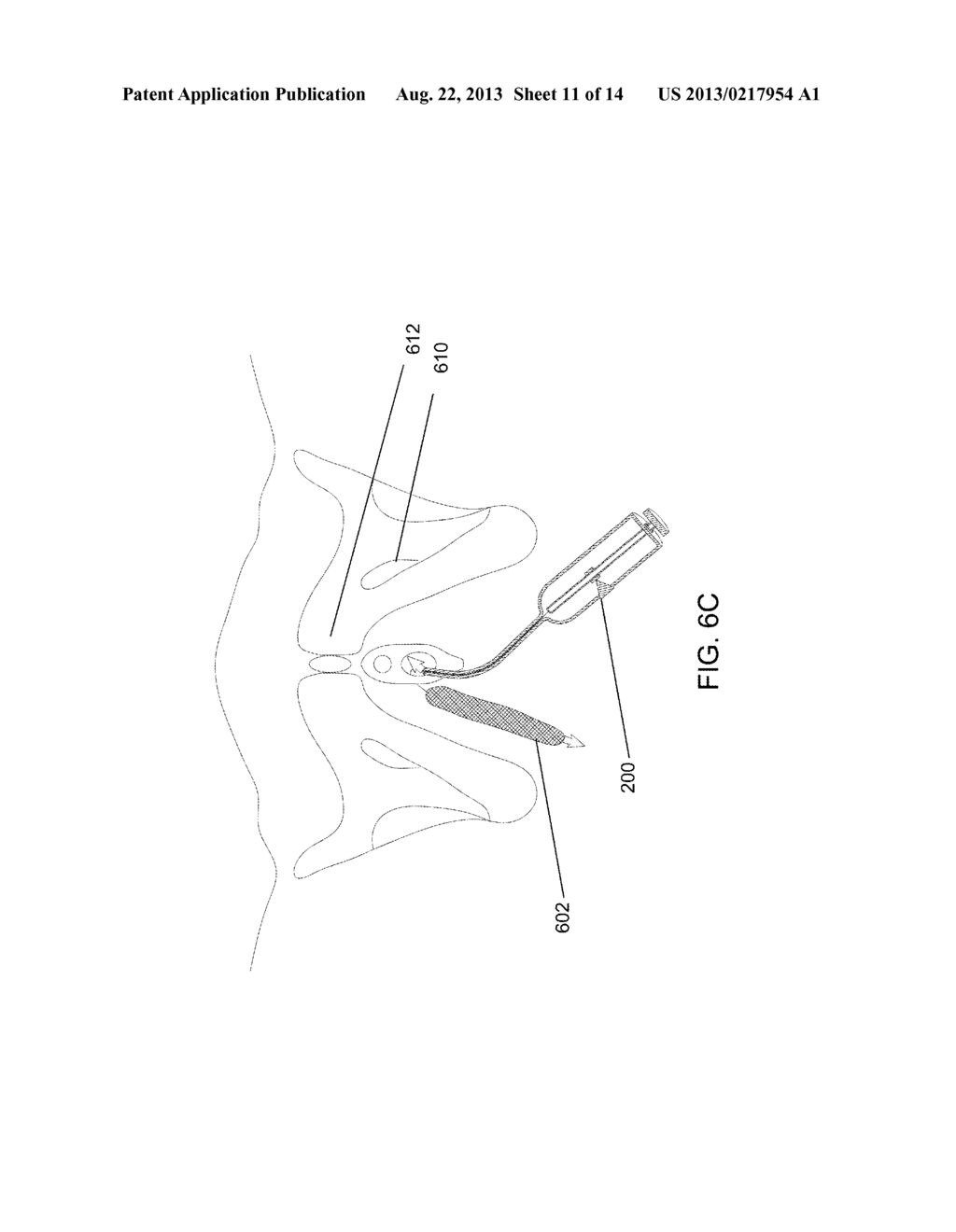 ADJUSTABLE MEDICAL ASSEMBLY FOR IMPLANT TENSION ADJUSTMENT - diagram, schematic, and image 12