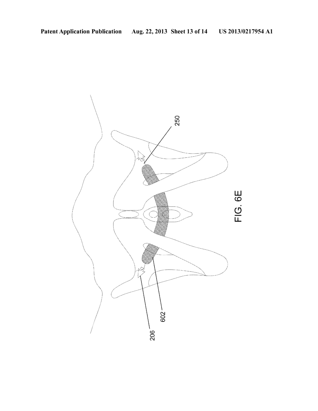 ADJUSTABLE MEDICAL ASSEMBLY FOR IMPLANT TENSION ADJUSTMENT - diagram, schematic, and image 14