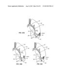 Minimally Invasive Lung Volume Reduction Devices, Methods, and Systems diagram and image