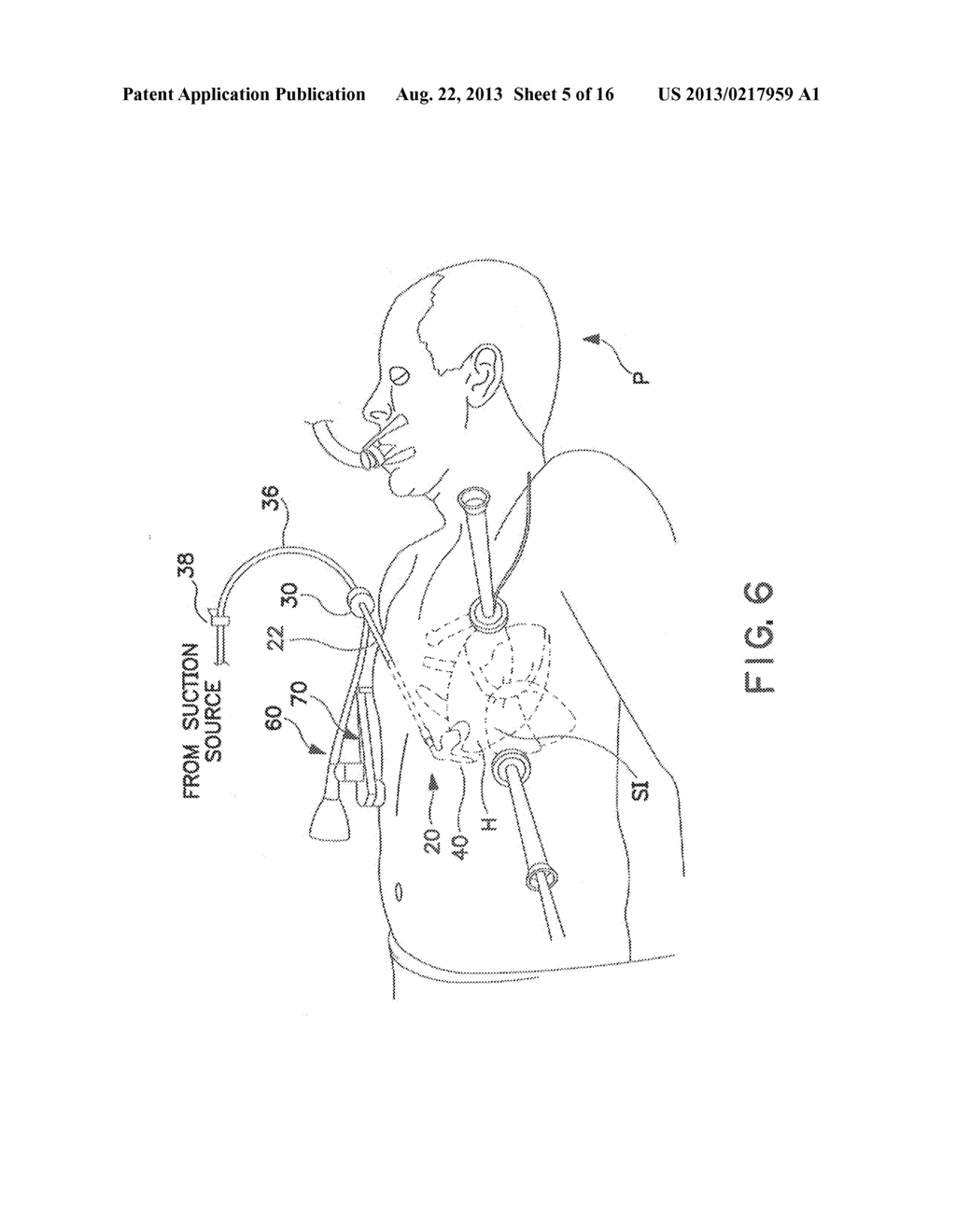 Methods and Apparatus Providing Suction-Assisted Tissue Engagement Through     a Minimally Invasive Incision - diagram, schematic, and image 06