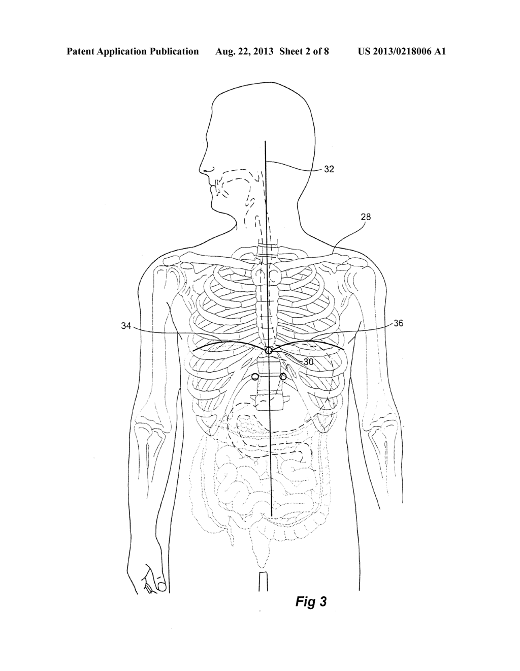 CATHETER LOCATOR APPARATUS AND METHOD OF USE - diagram, schematic, and image 03