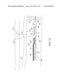 SEPARATION DEVICE FOR ULTRASOUND ELEMENT diagram and image