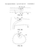 SEPARATION DEVICE FOR ULTRASOUND ELEMENT diagram and image